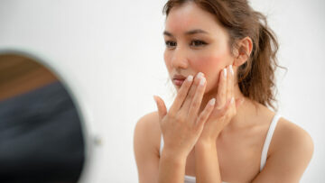 Unreine Haut, Pickel und Mitesser