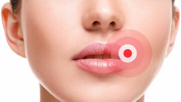 Was bei Lippenherpes hilft