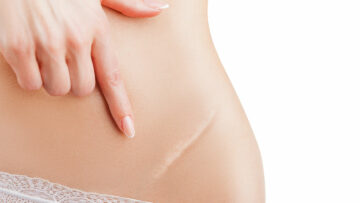 Richtige Pflege von Narben